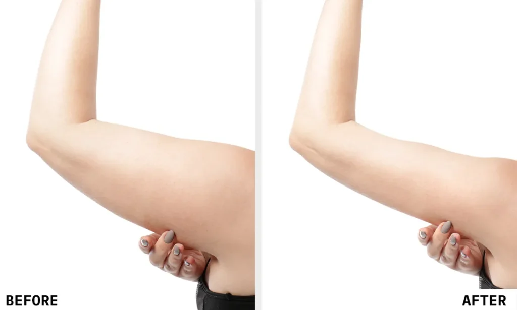 Fat Freezing Before After