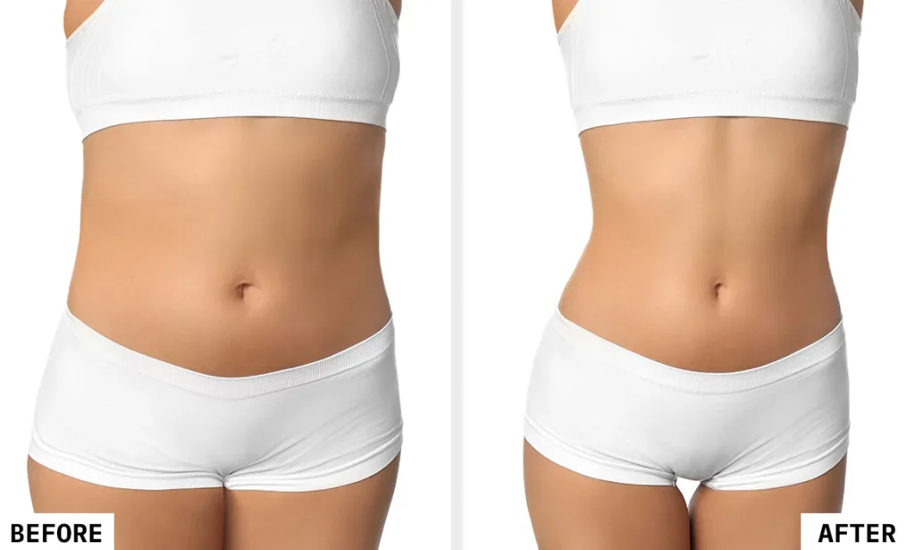 Fat Freezing Before After