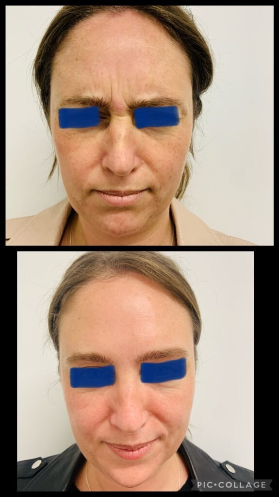 Antiwrinkle injectable
