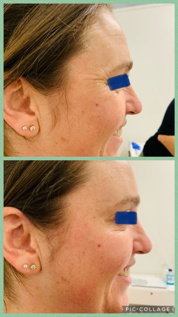 Antiwrinkle injectable