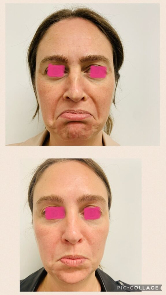 Antiwrinkle injectable