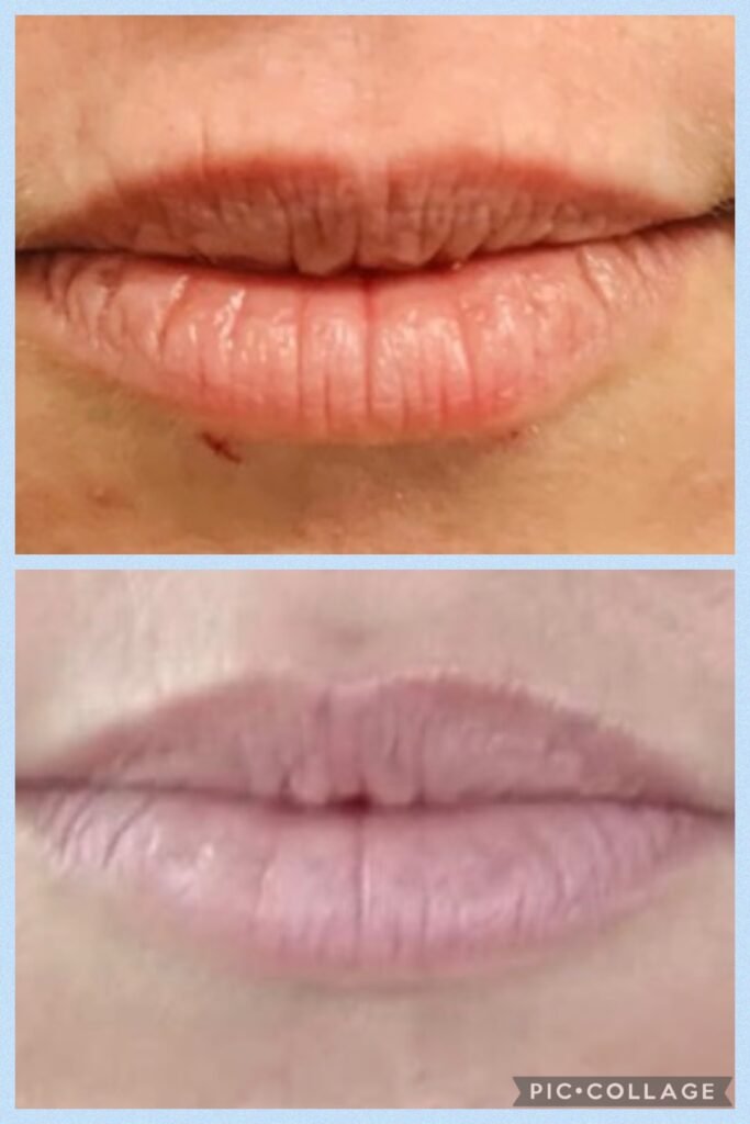 Antiwrinkle injectable