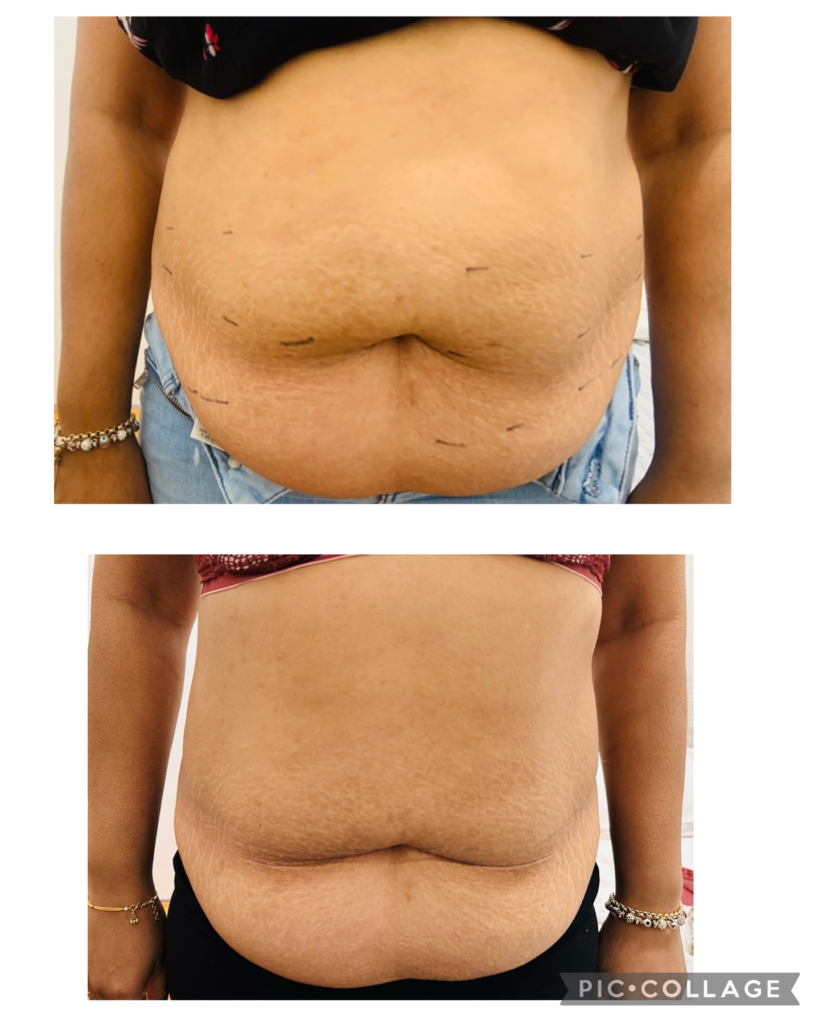 Figureit Laser Clinic Results