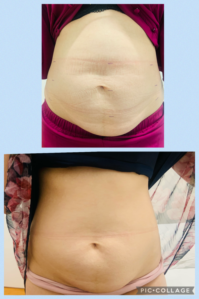 Figureit Laser Clinic Results