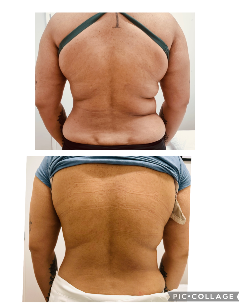 Figureit Laser Clinic Results