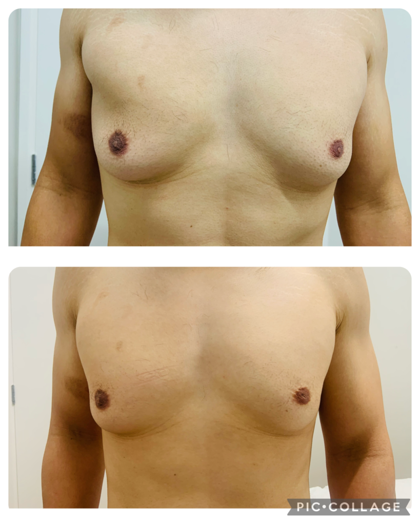 Figureit Laser Clinic Results