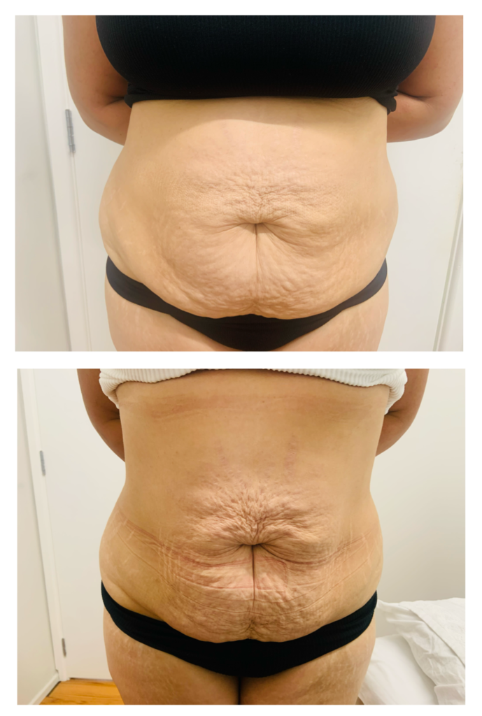 Figureit Laser Clinic Results
