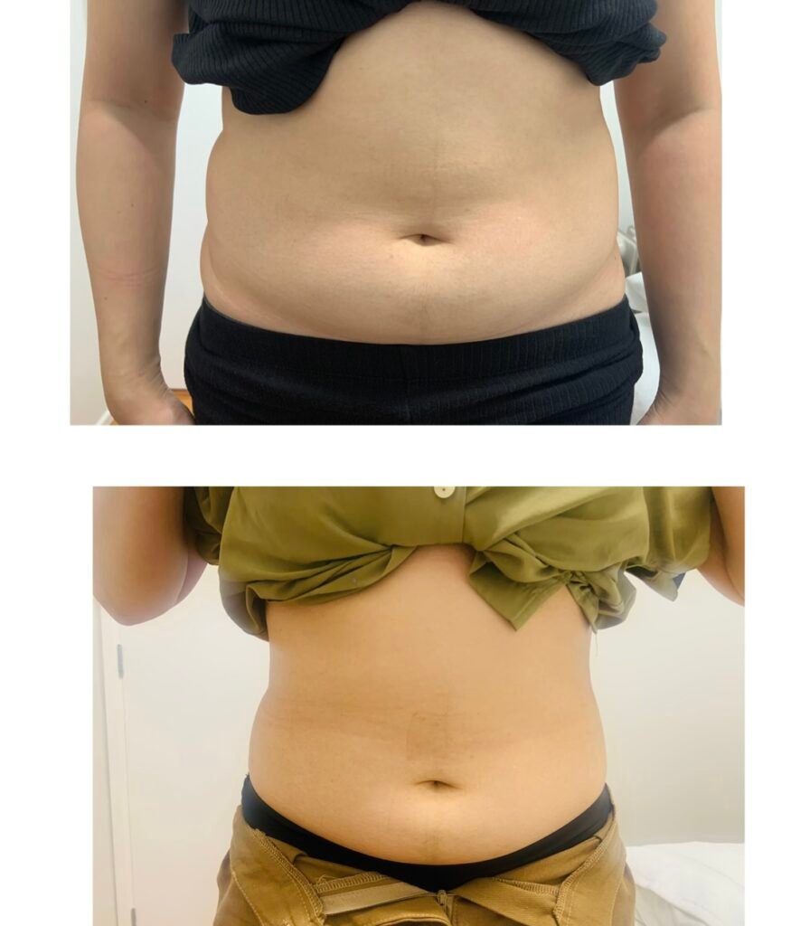 Figureit Laser Clinic Results