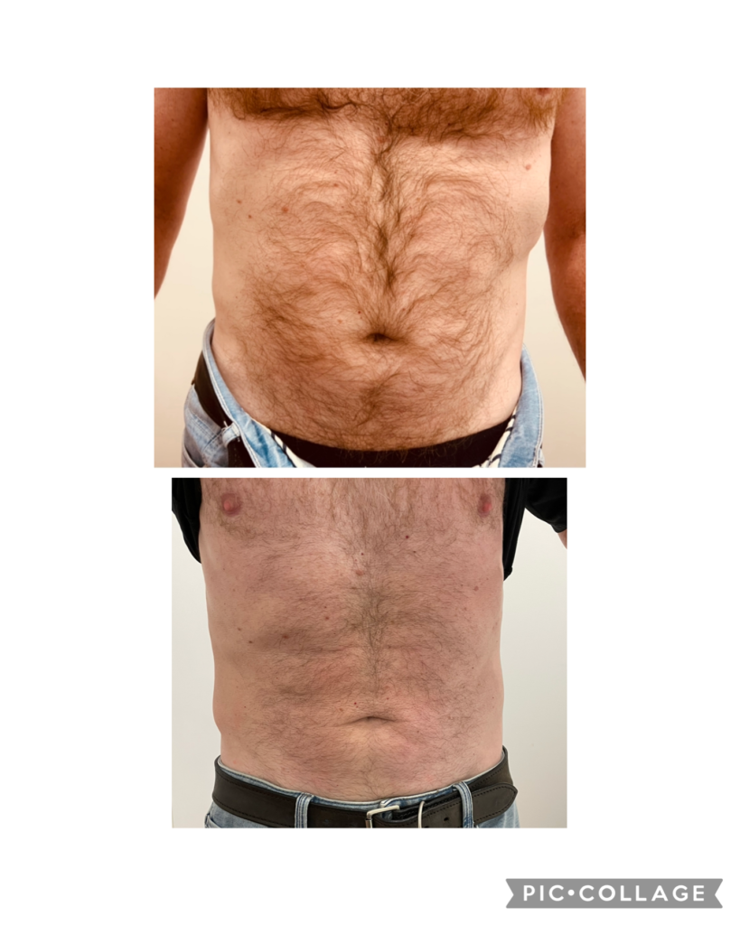 Figureit Laser Clinic Results