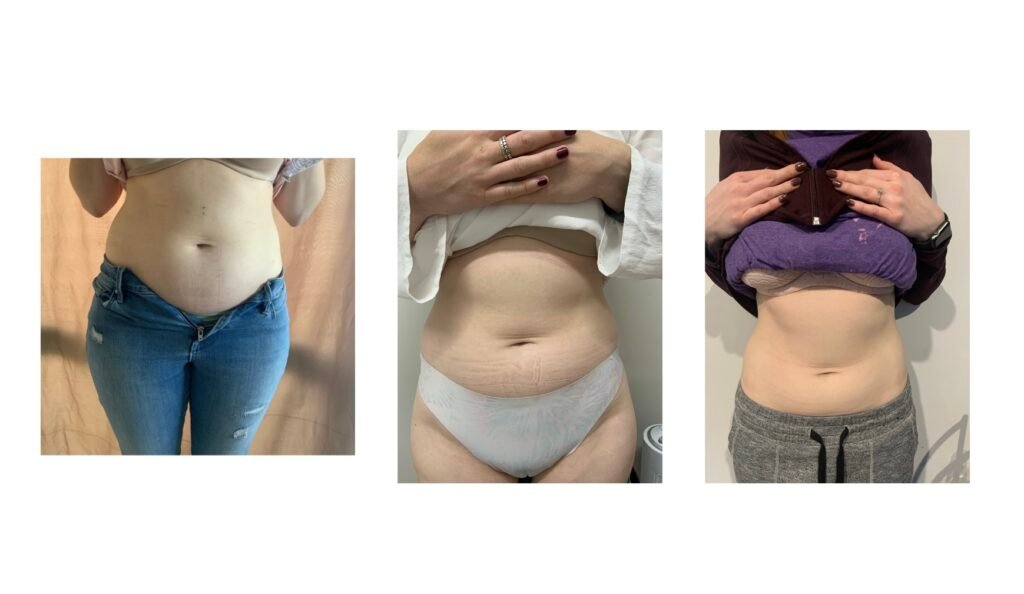 Fat Freezing